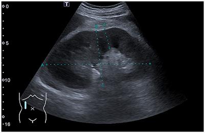 Case report: Acute kidney injury as the initial manifestation of chronic lymphocytic leukemia/small lymphocytic lymphoma